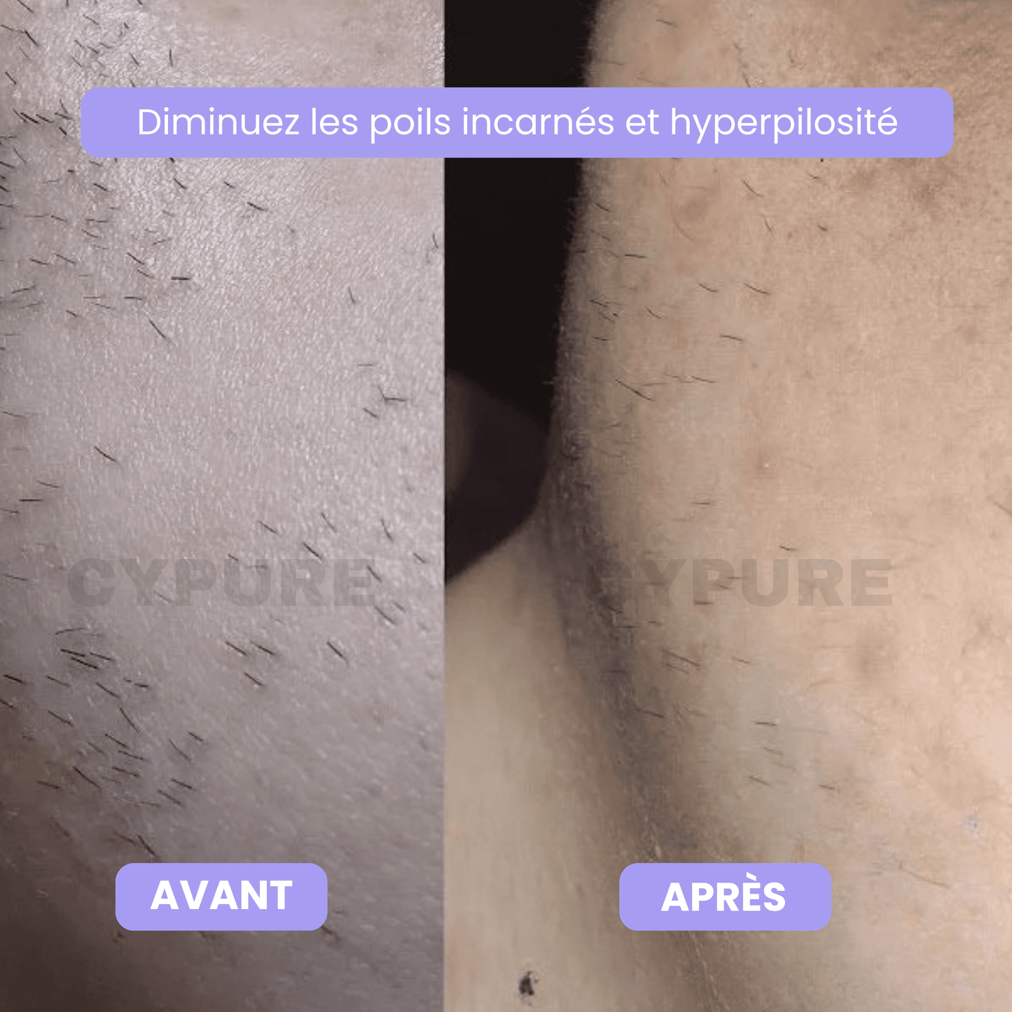 Cypure™ – Sérum Anti-Repousse Naturel