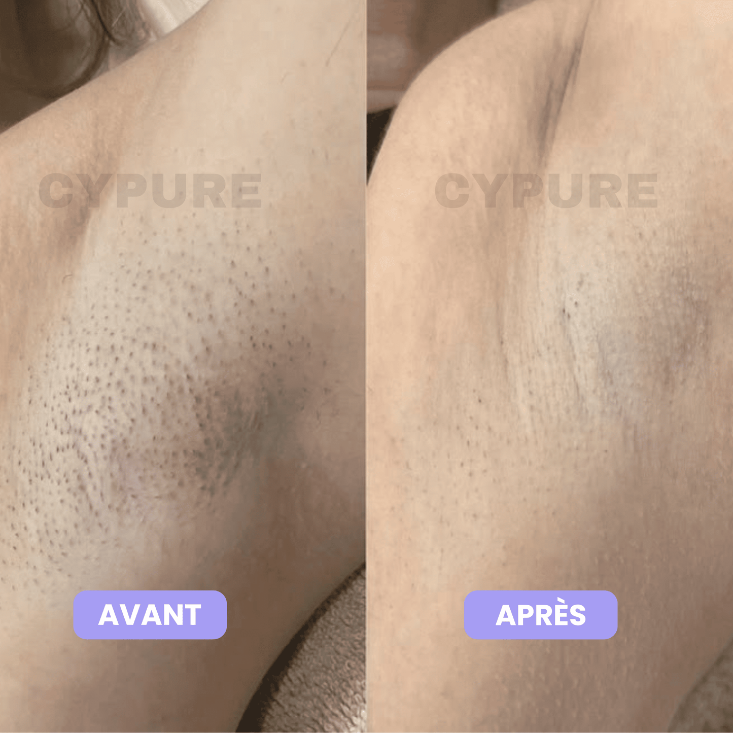 Cypure™ – Sérum Anti-Repousse Naturel